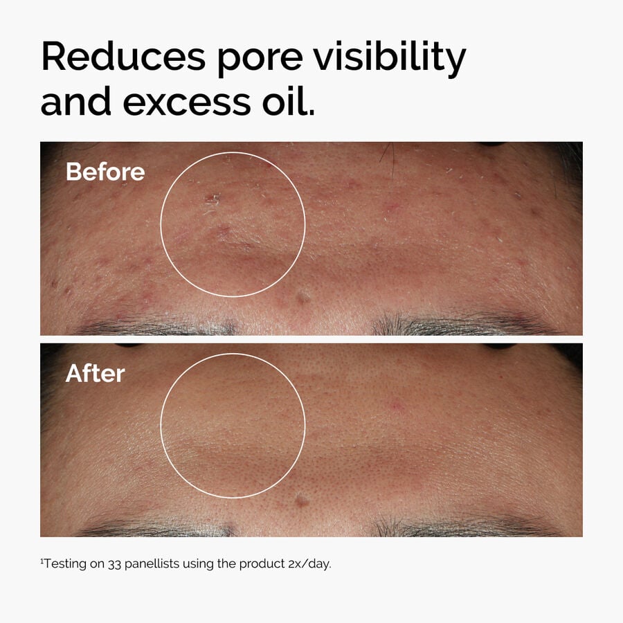 niacinamide-10-zinc-1-p0 ord-niacinamide-zinc-blemish-serum-before-after-pores.jpg