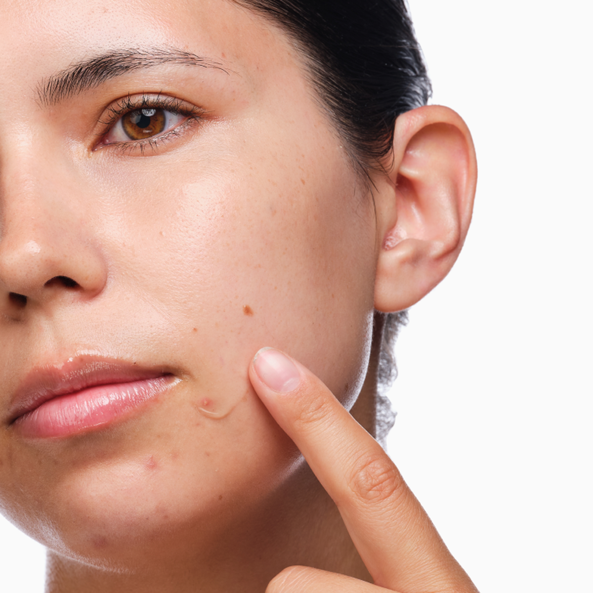 the-acne-set-p1 rdn-the-acne-set-application.png